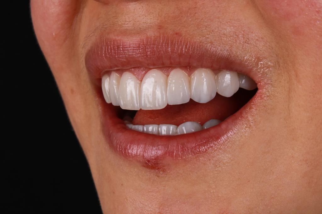 Después diseño dental